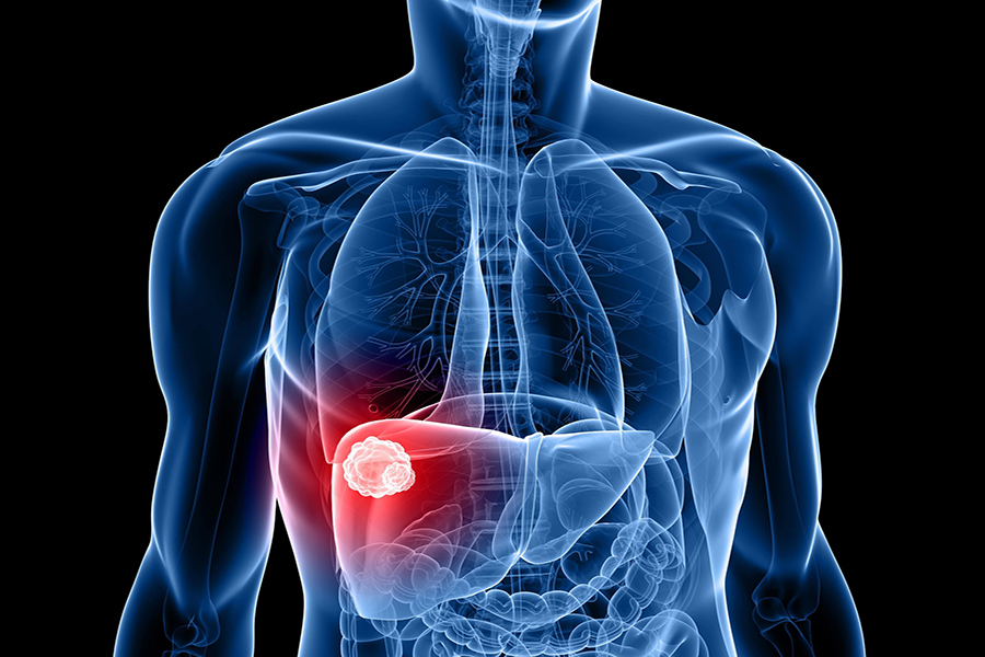 liver-cancer-min-scaled